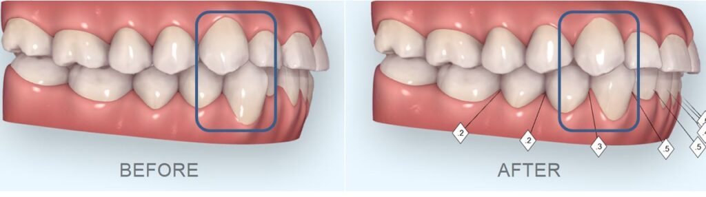 치아 교정 시뮬레이션