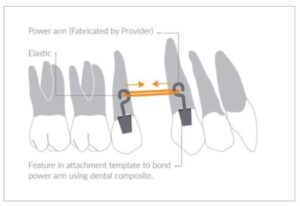 Invisalign power arm