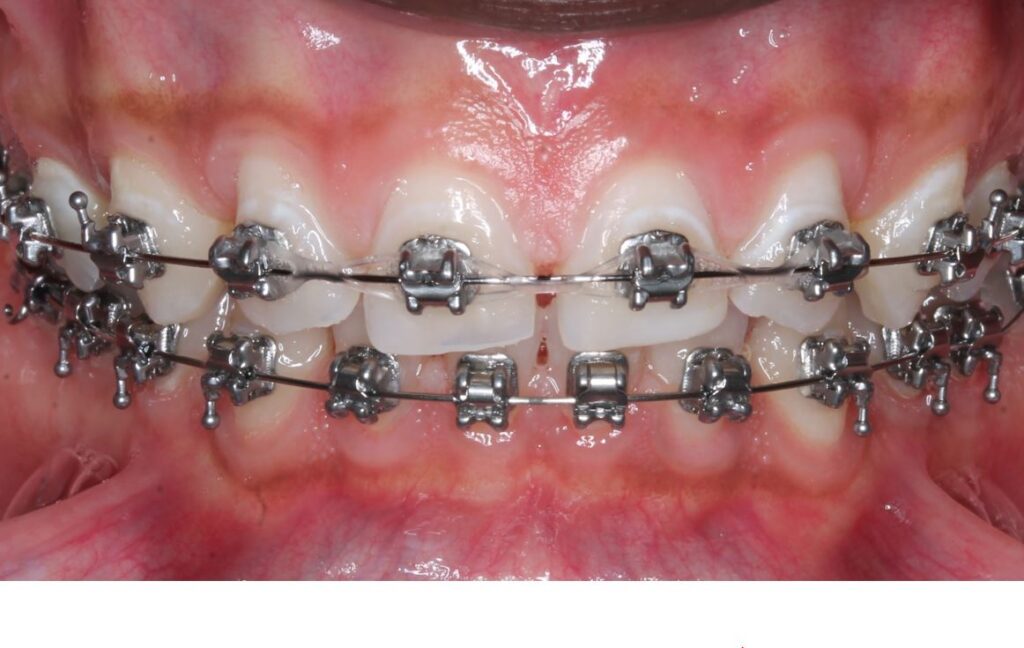 Silver (metal) braces