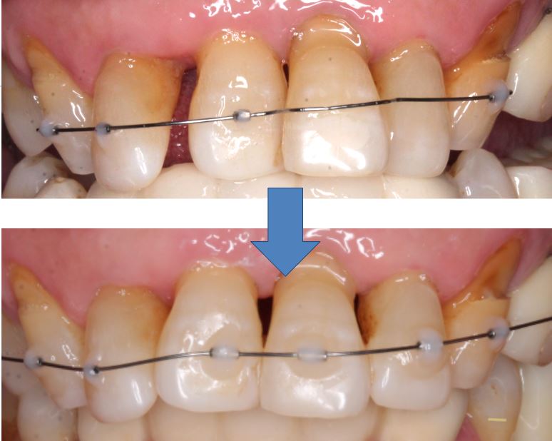Mini orthodontic braces