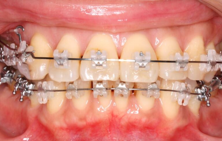Ceramic braces