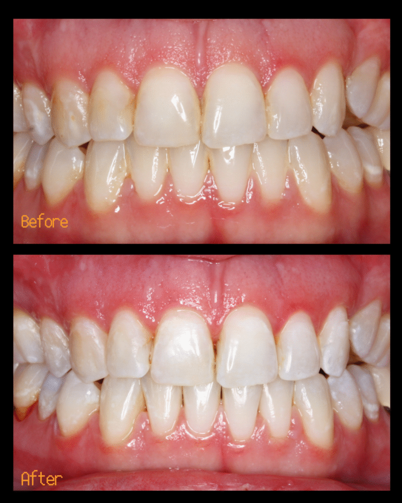 Air Polishing