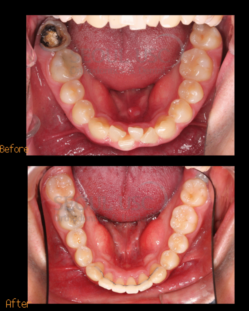 Wisdom tooth replacement
