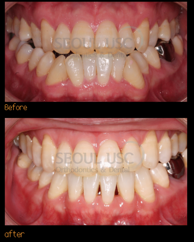 Crowding,, Cl III malocclusion