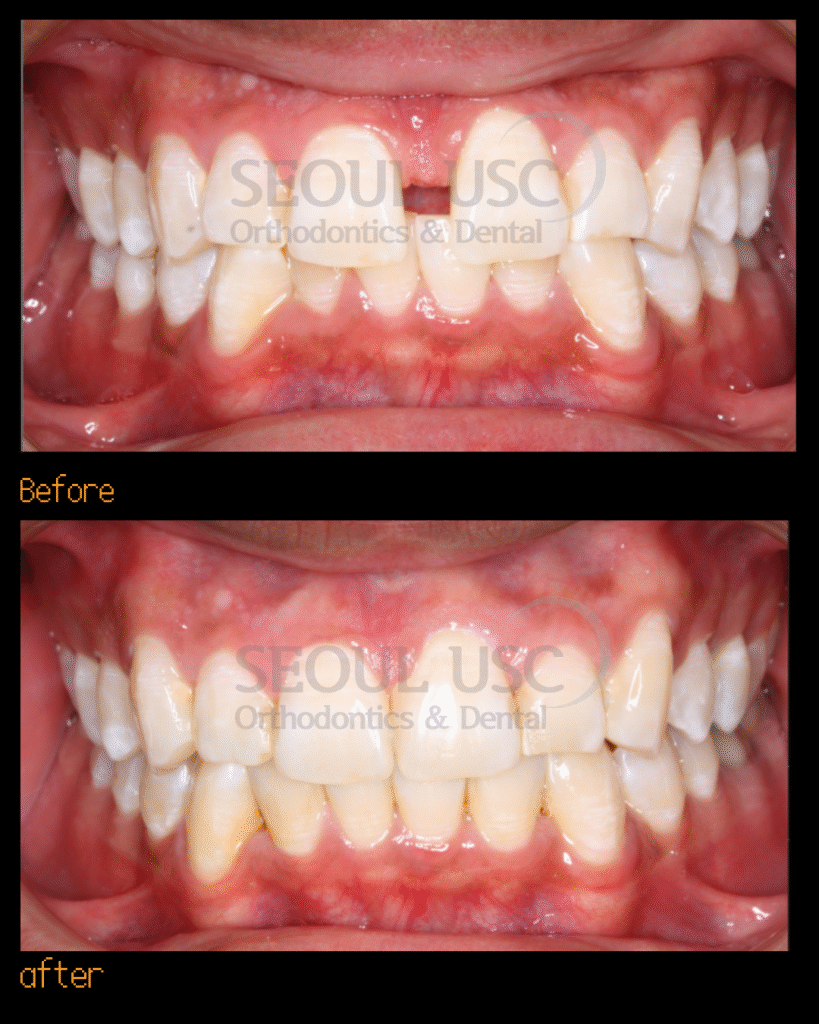Gap in front teeth