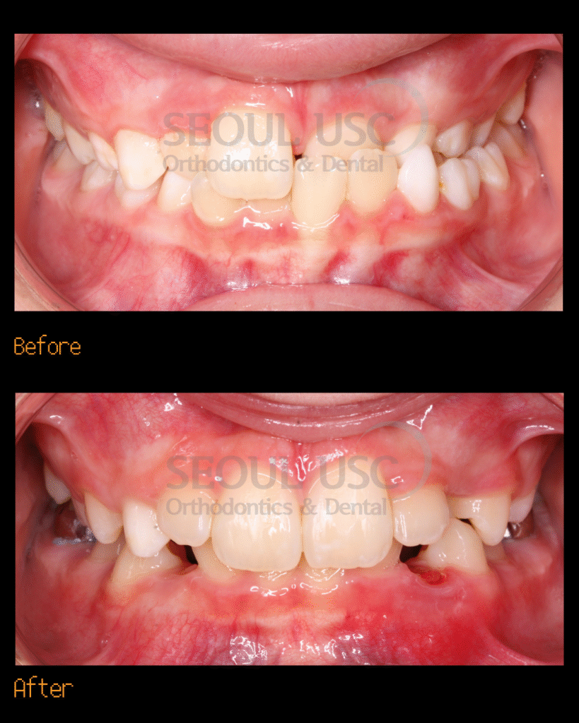 Unilateral crossbite