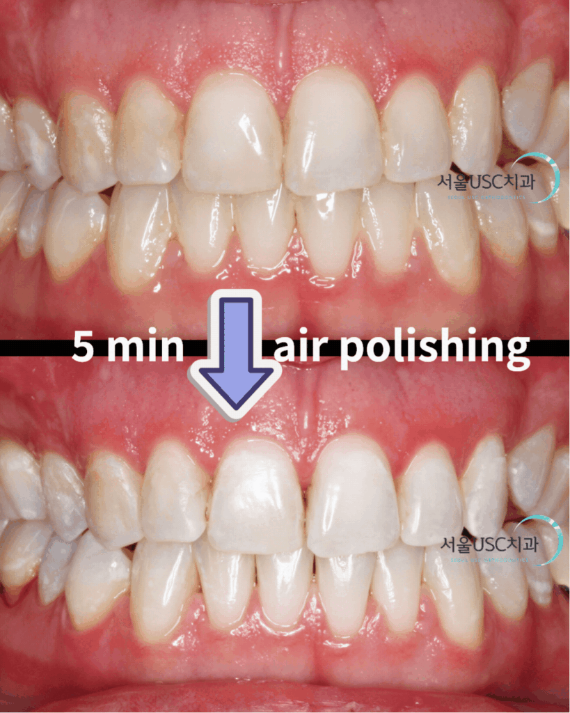Air polishing
